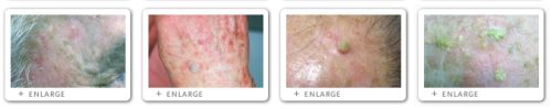 Click to view Actinic Keratosis images