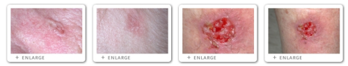 Click to view Basal Cell Carcinoma images