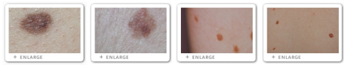 Click to view Images of Moles