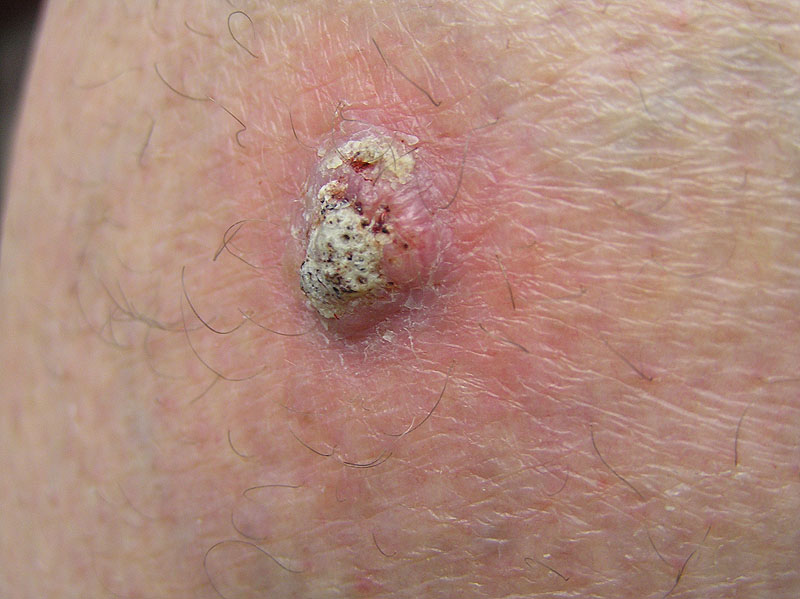 squamous cell carcinoma - Skin Cancer Foundation