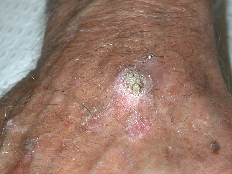 Basal Squamous Cell Skin Cancer